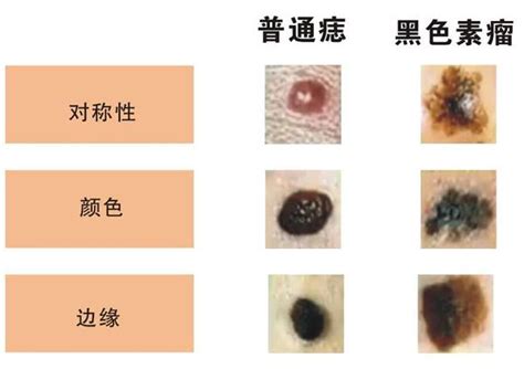 不規則黑痣|我的「痣」會是惡性腫瘤嗎？醫師告訴你：符合這5特。